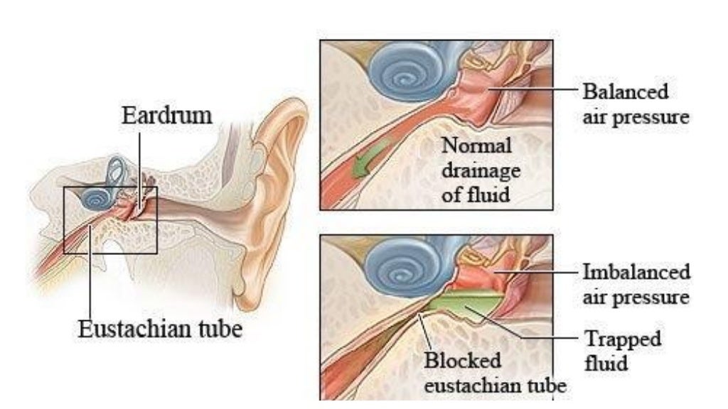 barotrauma ear bombing barotrauma ear bombing
