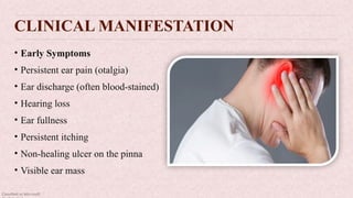 Classified as Microsoft
CLINICAL MANIFESTATION
• Early Symptoms
• Persistent ear pain (otalgia)
• Ear discharge (often blood-stained)
• Hearing loss
• Ear fullness
• Persistent itching
• Non-healing ulcer on the pinna
• Visible ear mass
 
