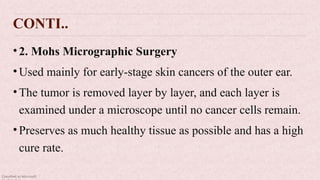 Classified as Microsoft
CONTI..
•2. Mohs Micrographic Surgery
•Used mainly for early-stage skin cancers of the outer ear.
•The tumor is removed layer by layer, and each layer is
examined under a microscope until no cancer cells remain.
•Preserves as much healthy tissue as possible and has a high
cure rate.
 