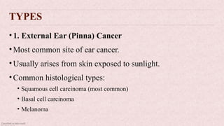 Classified as Microsoft
TYPES
•1. External Ear (Pinna) Cancer
•Most common site of ear cancer.
•Usually arises from skin exposed to sunlight.
•Common histological types:
• Squamous cell carcinoma (most common)
• Basal cell carcinoma
• Melanoma
 