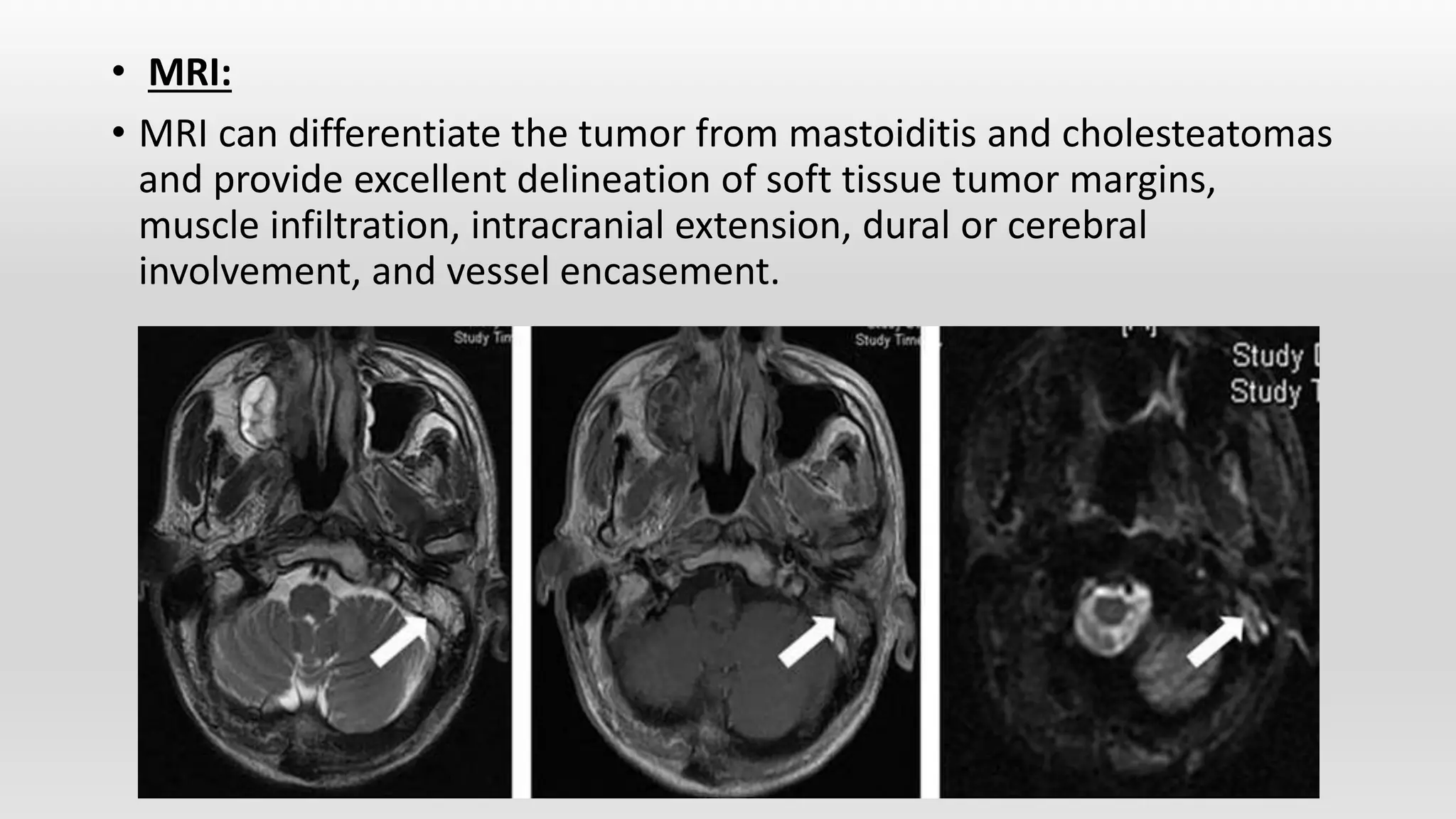 Ear carcinoma | PPTX