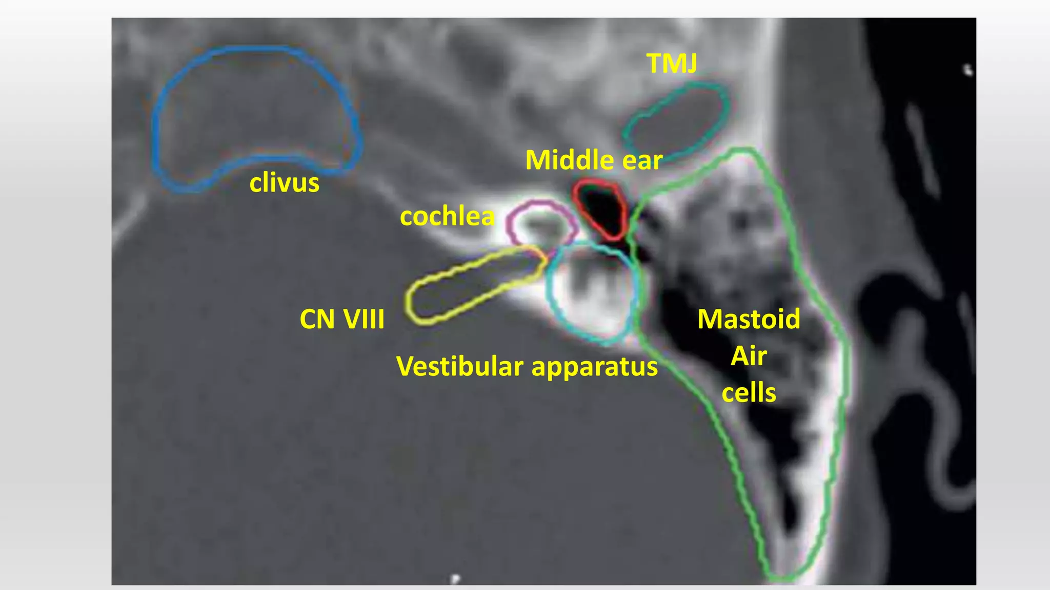 Ear carcinoma | PPTX