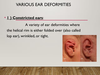 Ear deformities.pptxFFFFFFFFFFFFFFFFFFFFFFFFFF | PPTX