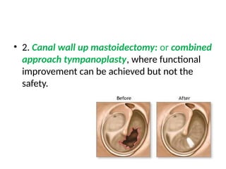• 2. Canal wall up mastoidectomy: or combined
approach tympanoplasty, where functional
improvement can be achieved but not the
safety.
 