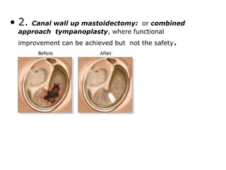 • 2. Canal wall up mastoidectomy: or combined
approach tympanoplasty, where functional
improvement can be achieved but not the safety.
 