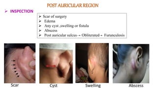 POST AURICULARREGION
 INSPECTION
Scar Cyst Abscess
 Scar of surgery
 Edema
 Any cyst ,swelling or fistula
 Abscess
 Post auricular sulcus Obliterated Furunculosis
Swelling
 