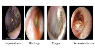 Impacted wax Discharge Fungus Keratosis obturans
 