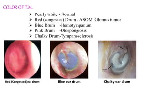 COLOR OF T.M.
 Pearly white - Normal
 Red (congested) Drum - ASOM, Glomus tumor
 Blue Drum -Hemotympanum
 Pink Drum -Otospongiosis
 Chalky Drum-Tympanosclerosis
Red (Congested)ear drum Blue ear drum Chalky ear drum
 