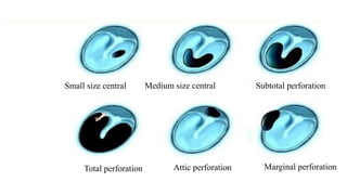 hkjklhjghglhjhjjkg
gkhgkhkhkk
Small size central Medium size central Subtotal perforation
Total perforation Attic perforation Marginal perforation
 