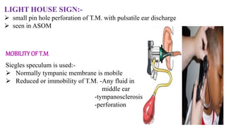 Siegles speculum is used:-
 Normally tympanic membrane is mobile
 Reduced or immobility of T.M. -Any fluid in
middle ear
-tympanosclerosis
-perforation
LIGHT HOUSE SIGN:-
 small pin hole perforation of T.M. with pulsatile ear discharge
 seen in ASOM
MOBILITY OF T.M.
 