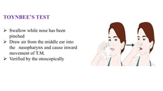 TOYNBEE’S TEST
 Swallow while nose has been
pinched
 Draw air from the middle ear into
the nasopharynx and cause inward
movement of T.M.
 Verified by the otoscopically
 