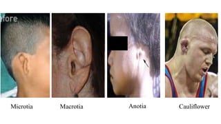 Anotia
Microtia Macrotia Cauliflower
 