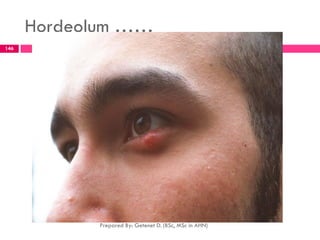 Hordeolum ……
Prepared By: Getenet D. (BSc, MSc in AHN)
146
 
