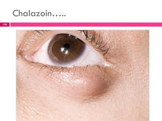 Chalazoin…..
Prepared By: Getenet D. (BSc, MSc in AHN)
150
 