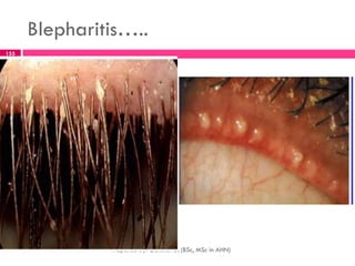 Blepharitis…..
Prepared By: Getenet D. (BSc, MSc in AHN)
155
 