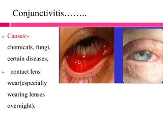 Conjunctivitis……..
 Causes:-
chemicals, fungi,
certain diseases,
 contact lens
wear(especially
wearing lenses
overnight).
 