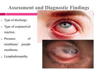 Assessment and Diagnostic Findings
 Type of discharge.
 Type of conjunctival
reaction.
 Presence of
membrane/ pseudo
membrane.
 Lymphadenopathy.
 
