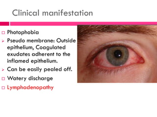 Clinical manifestation
 Photophobia
 Pseudo membrane: Outside
epithelium, Coagulated
exudates adherent to the
inflamed epithelium.
 Can be easily pealed off.
 Watery discharge
 Lymphadenopathy
 