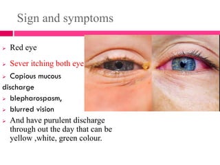 Sign and symptoms
 Red eye
 Sever itching both eye
 Copious mucous
discharge
 blepharospasm,
 blurred vision
 And have purulent discharge
through out the day that can be
yellow ,white, green colour.
 