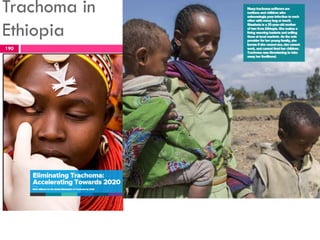 Trachoma in
Ethiopia
190
 