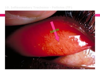10. Inflammatory Trachoma - Follicles (TF)
 