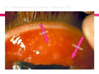 11. Inflammatory Trachoma - Intense (TI)
 