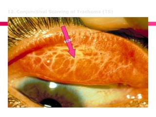 12. Conjunctival Scarring of Trachoma (TS)
 