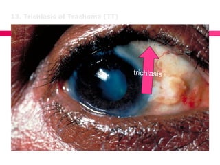 13. Trichiasis of Trachoma (TT)
 