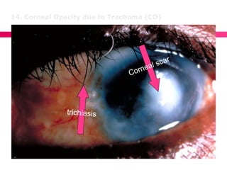14. Corneal Opacity due to Trachoma (CO)
 