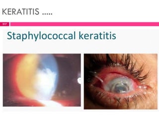 KERATITIS .....
217
 