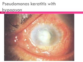 Pseudomonas keratitis with
hypopyon218
 