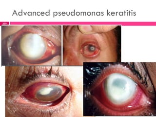 Advanced pseudomonas keratitis
219
 