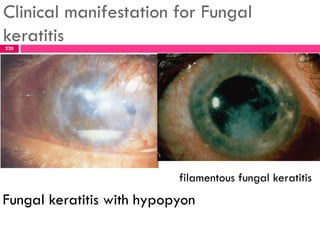 Clinical manifestation for Fungal
keratitis220
Fungal keratitis with hypopyon
filamentous fungal keratitis
 