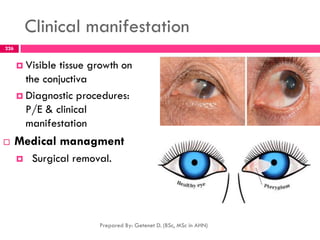 Clinical manifestation
 Visible tissue growth on
the conjuctiva
 Diagnostic procedures:
P/E & clinical
manifestation
 Medical managment
 Surgical removal.
Prepared By: Getenet D. (BSc, MSc in AHN)
226
 