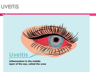 UVEITIS
228
 