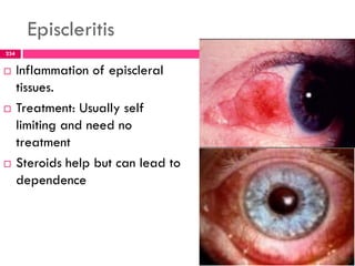 Episcleritis
 Inflammation of episcleral
tissues.
 Treatment: Usually self
limiting and need no
treatment
 Steroids help but can lead to
dependence
234
 