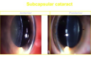Subcapsular cataract
Anterior Posterior
 