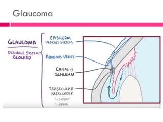Glaucoma
 