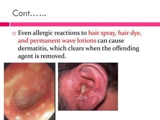 Cont.…..
 Even allergic reactions to hair spray, hair dye,
and permanent wave lotions can cause
dermatitis, which clears when the offending
agent is removed.
 