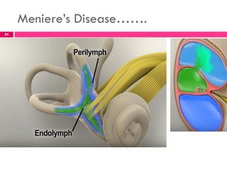Meniere’s Disease…….
84
 