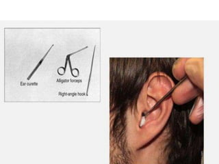 EAR FOREIGN BODY_ WAX IMPACTION .pptx