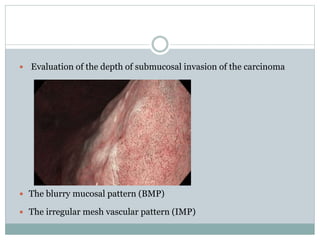 Mucosal Pattern Early gastric cancer | PPTX