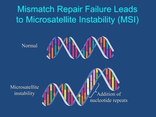Mismatch Repair Failure Leads
to Microsatellite Instability (MSI)
Normal
Microsatellite
instability Addition of
nucleotide repeats
 