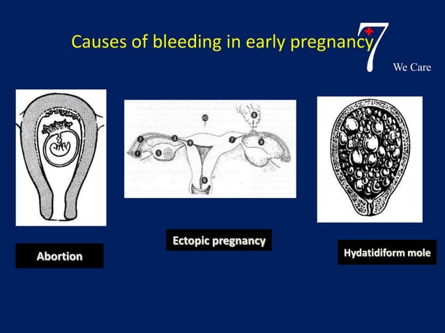 Bleeding in early pregnancy | PPTX | Infertility | Reproductive Health