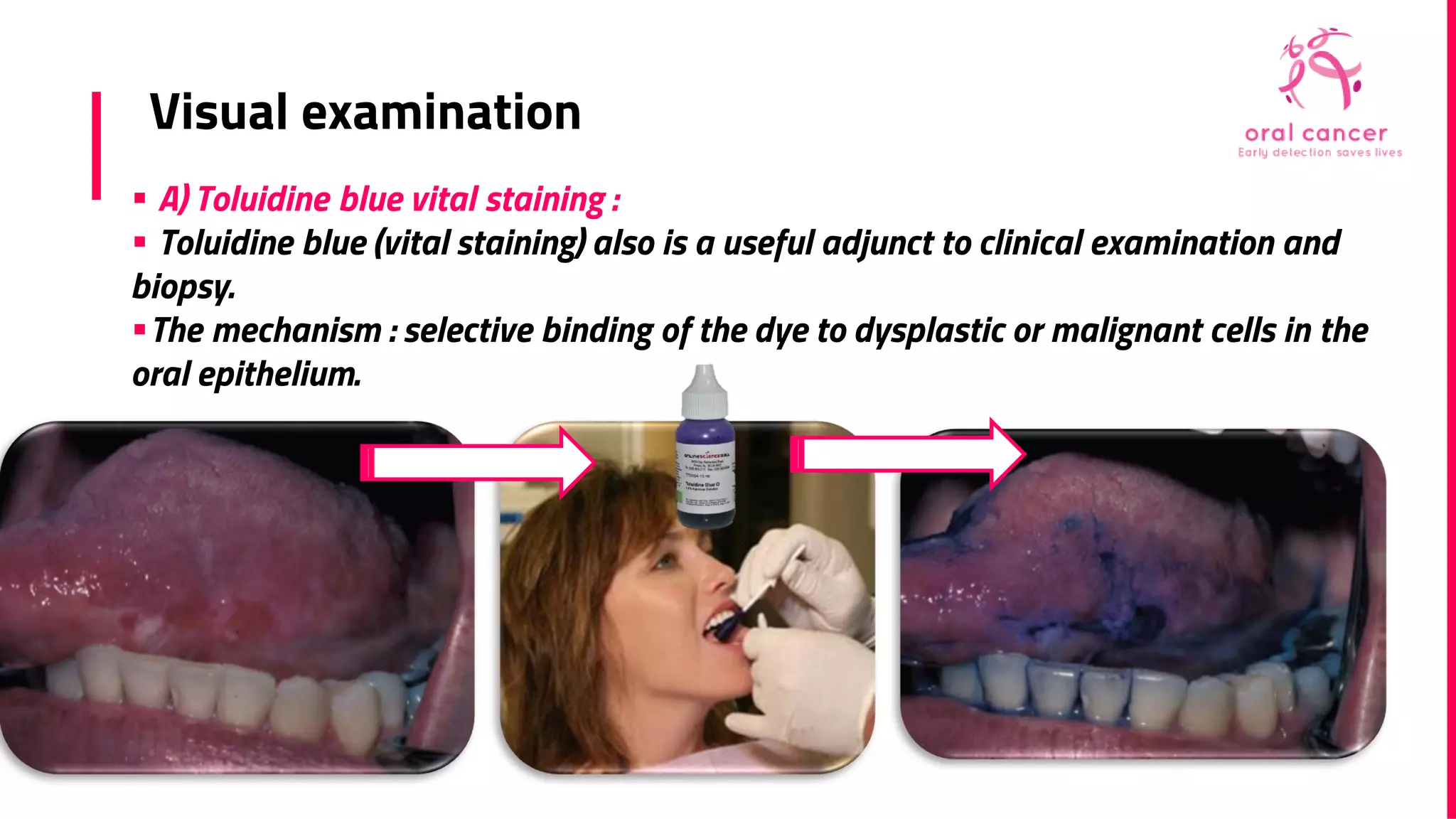 Early cancer detection ( oral cancer ) | PPT