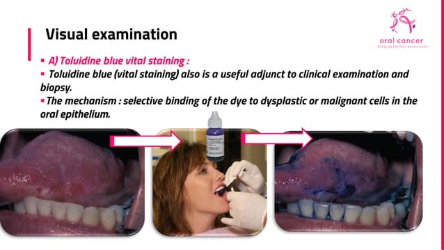 Early cancer detection ( oral cancer ) | PDF | Dental Health | Diseases ...