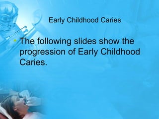Early Childhood Caries The following slides show the progression of Early Childhood Caries.  