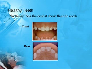 Healthy Teeth No Decay. Ask the dentist about fluoride needs. Front Rear 