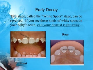 Early Decay Front Rear This stage, called the “White Spots” stage, can be reversed.  If you see these kinds of white spots on your baby’s teeth,  call your dentist right away . 