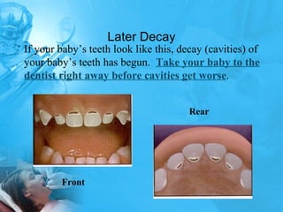 Later Decay Rear Front If your baby’s teeth look like this, decay (cavities) of your baby’s teeth has begun.  Take your baby to the dentist right away before cavities get worse . 